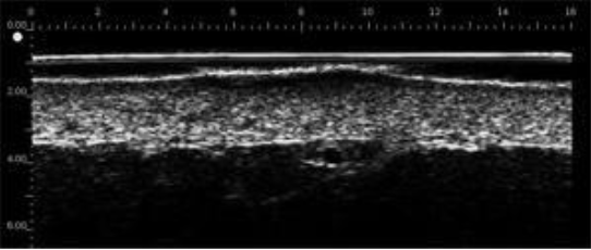 Carcinoma superficial