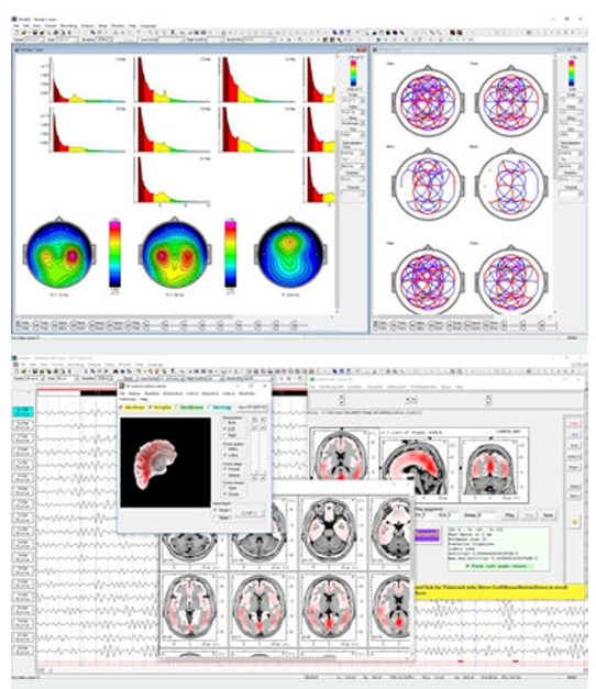 Mapas cuantitativos qEEG
