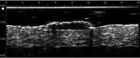 Queratosis seborreica