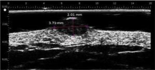 Carcinoma pigmentado