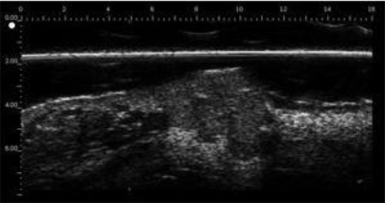 Angioma labial